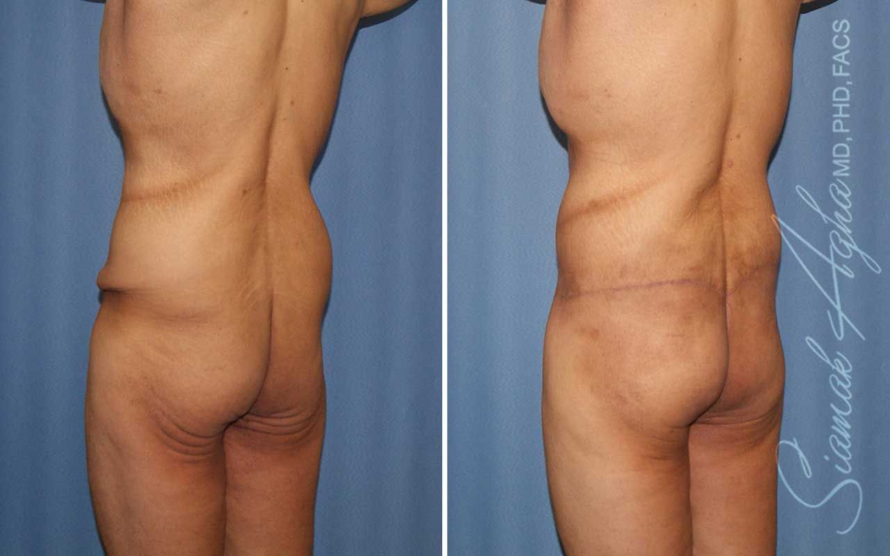 Lower Body Lift Before & After