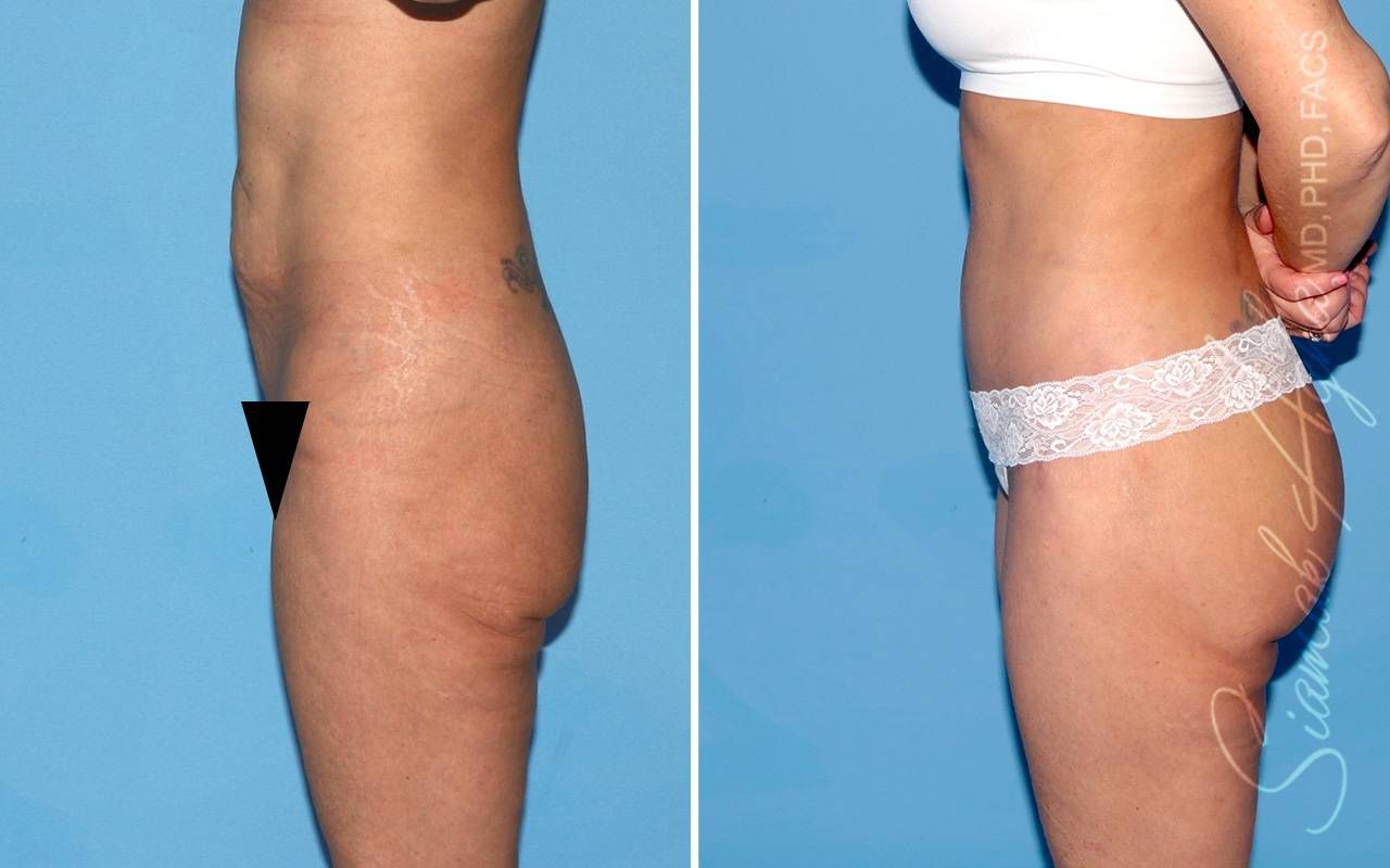 Lower Body Lift Before & After