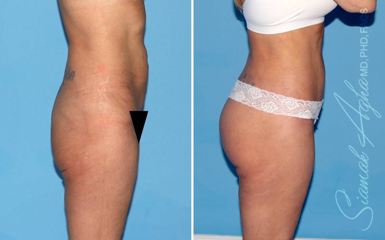Lower Body Lift Before & After