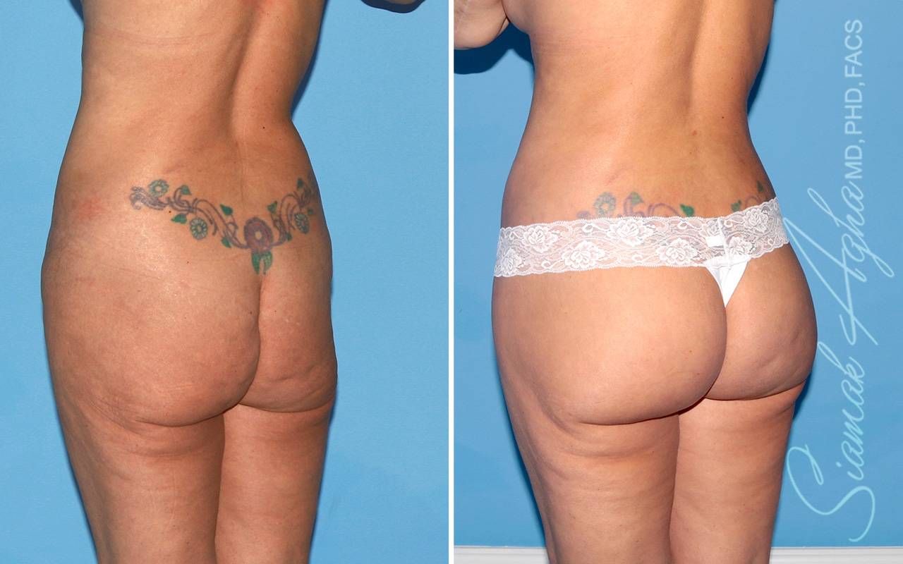 Lower Body Lift Before & After