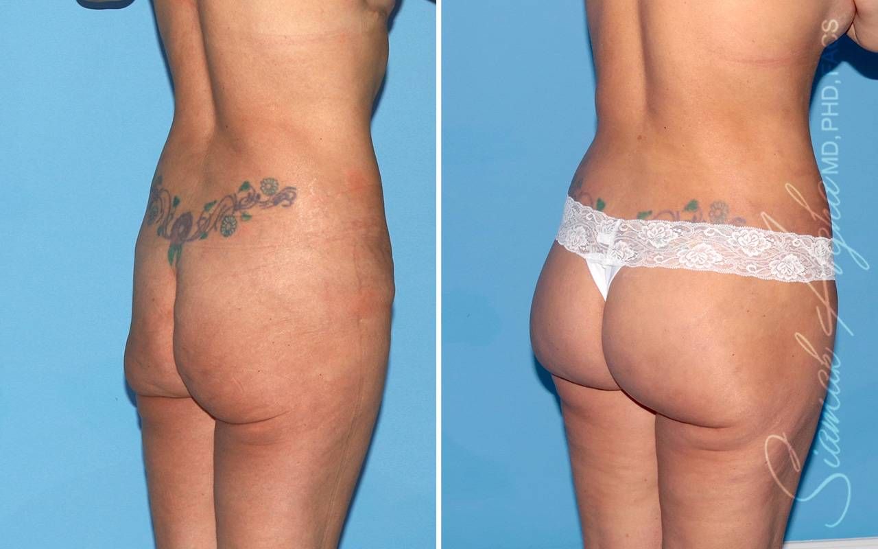 Lower Body Lift Before & After