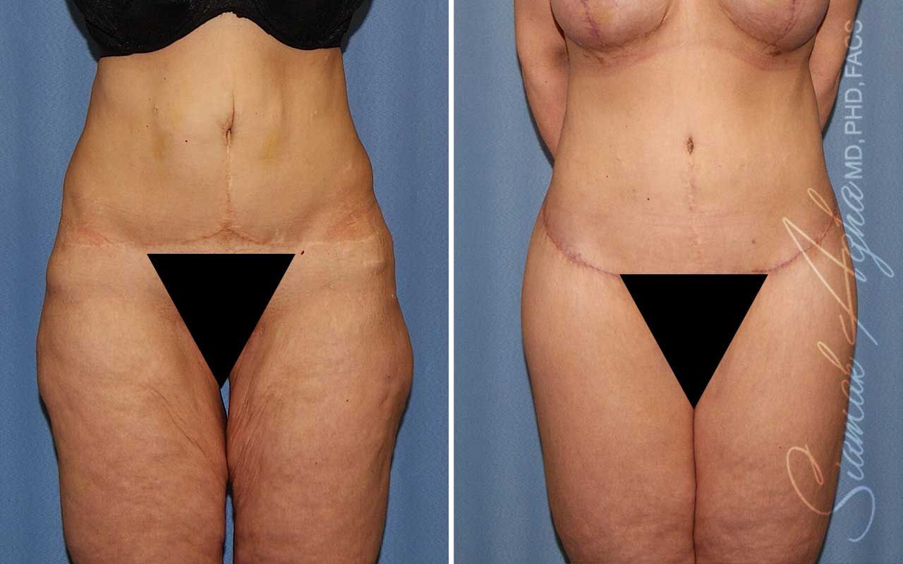 Lower Body Lift Before & After