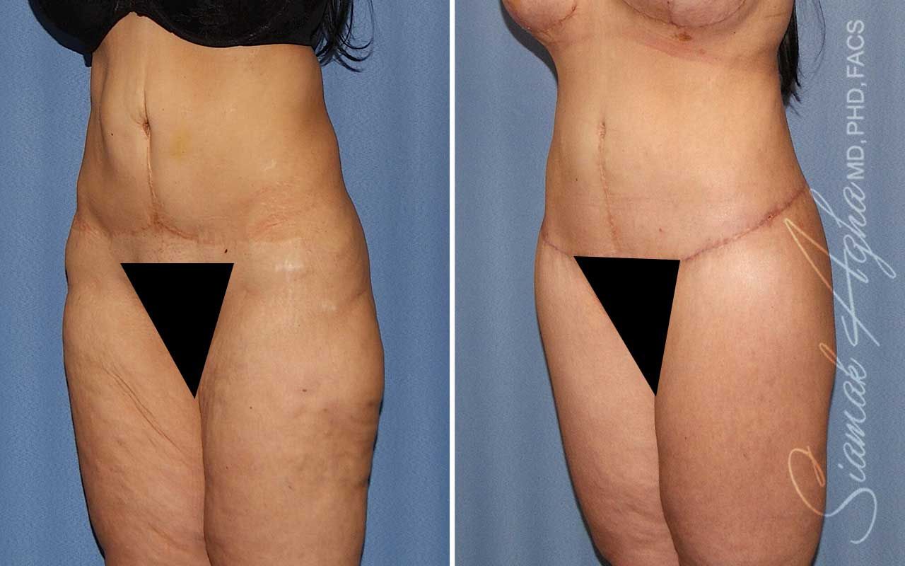 Lower Body Lift Before & After