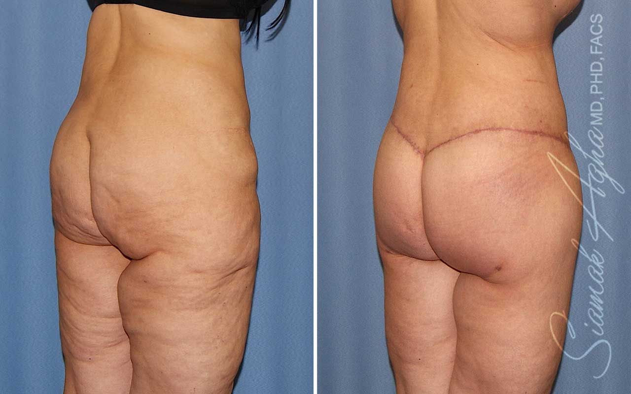Lower Body Lift Before & After