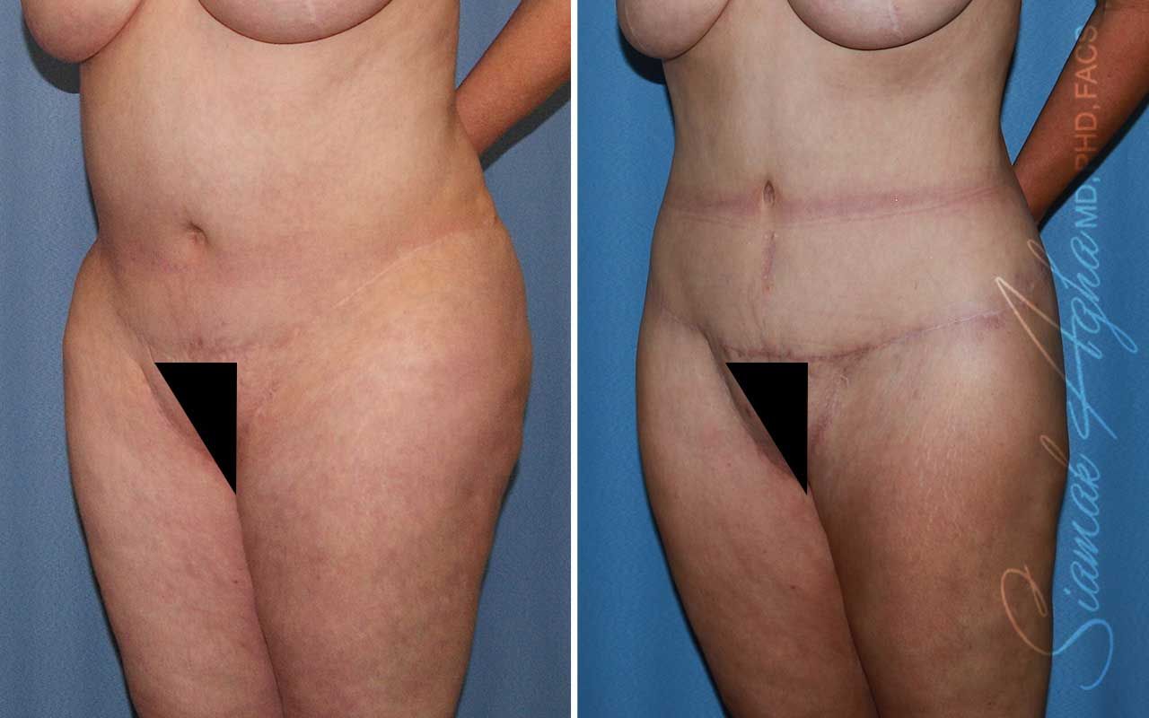 Lower Body Lift Before & After