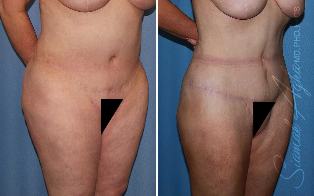 Lower Body Lift Before & After