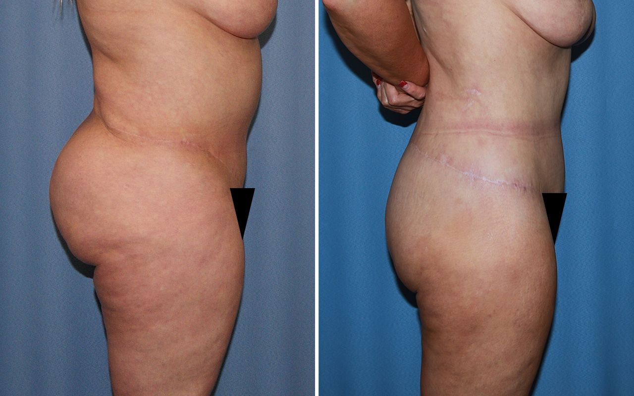 Lower Body Lift Before & After