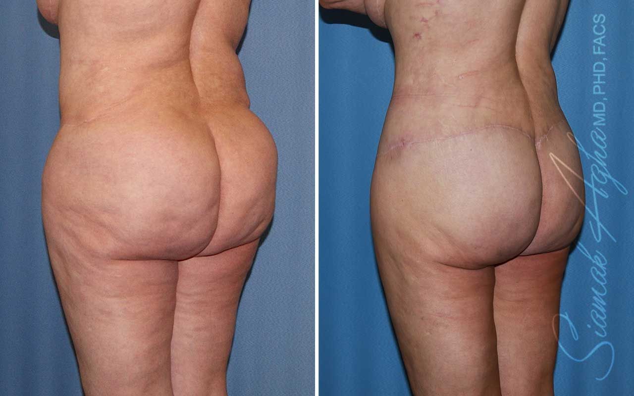 Lower Body Lift Before & After