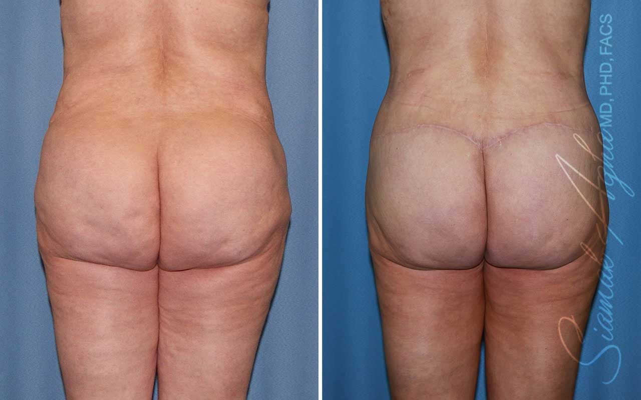 Lower Body Lift Before & After