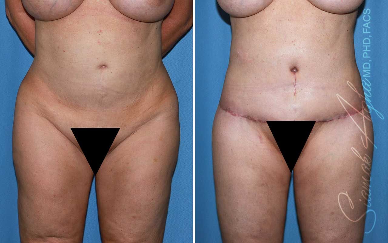 Lower Body Lift Before & After