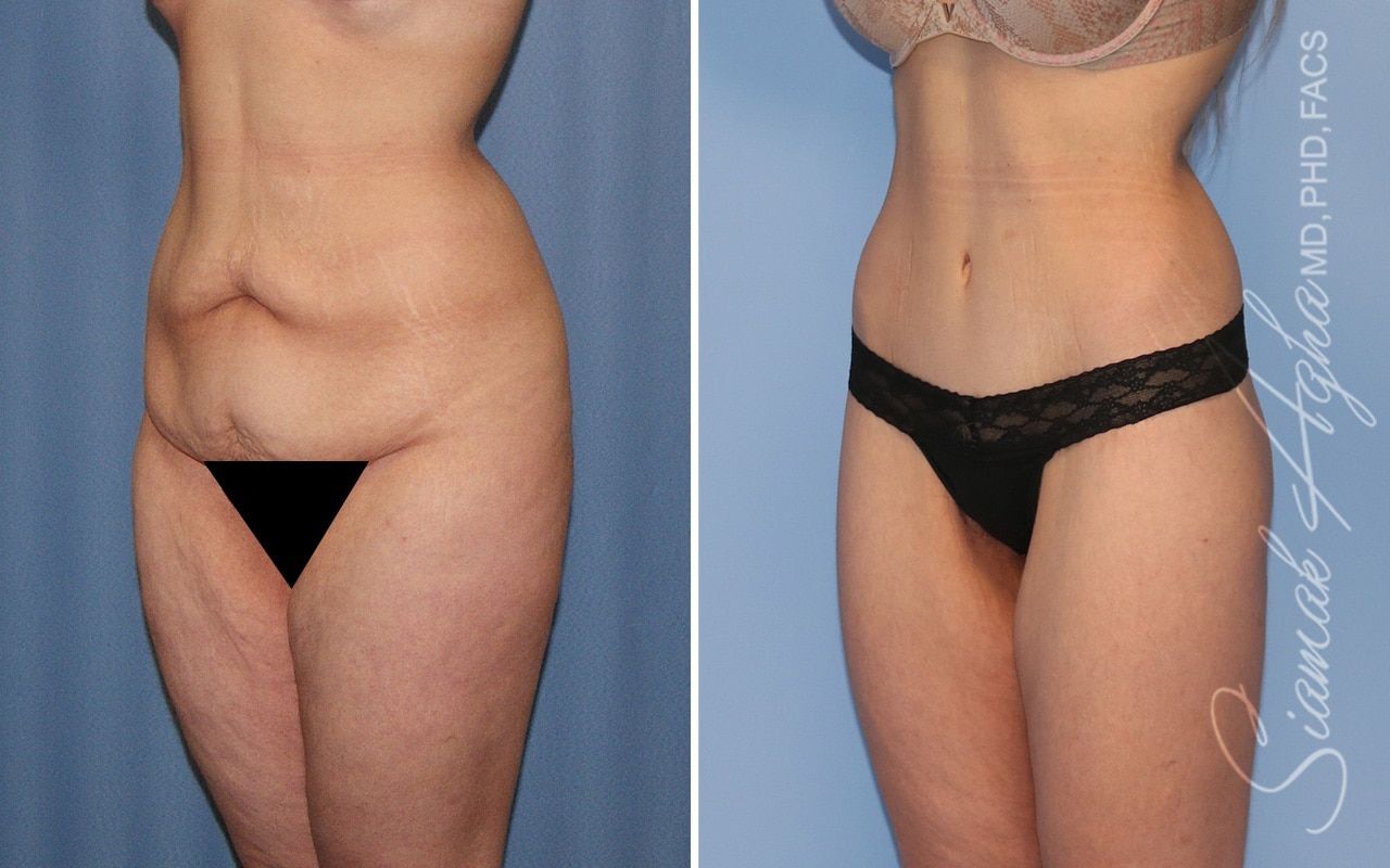 Lower Body Lift Before & After