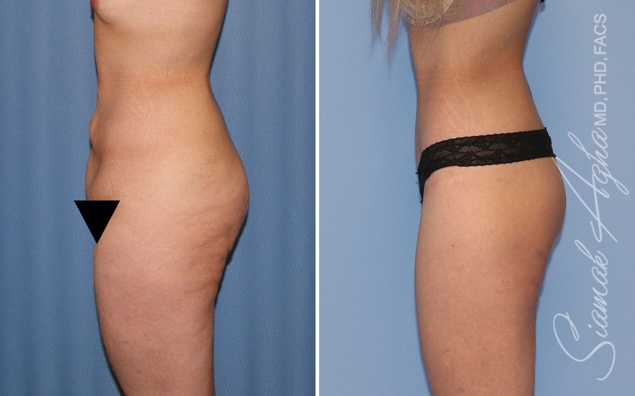 Lower Body Lift Before & After