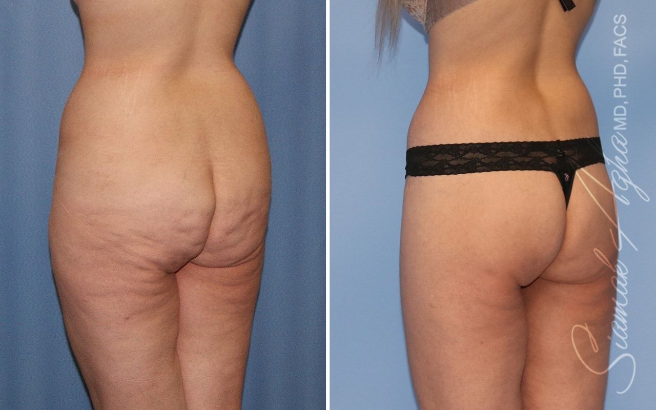 Lower Body Lift Before & After