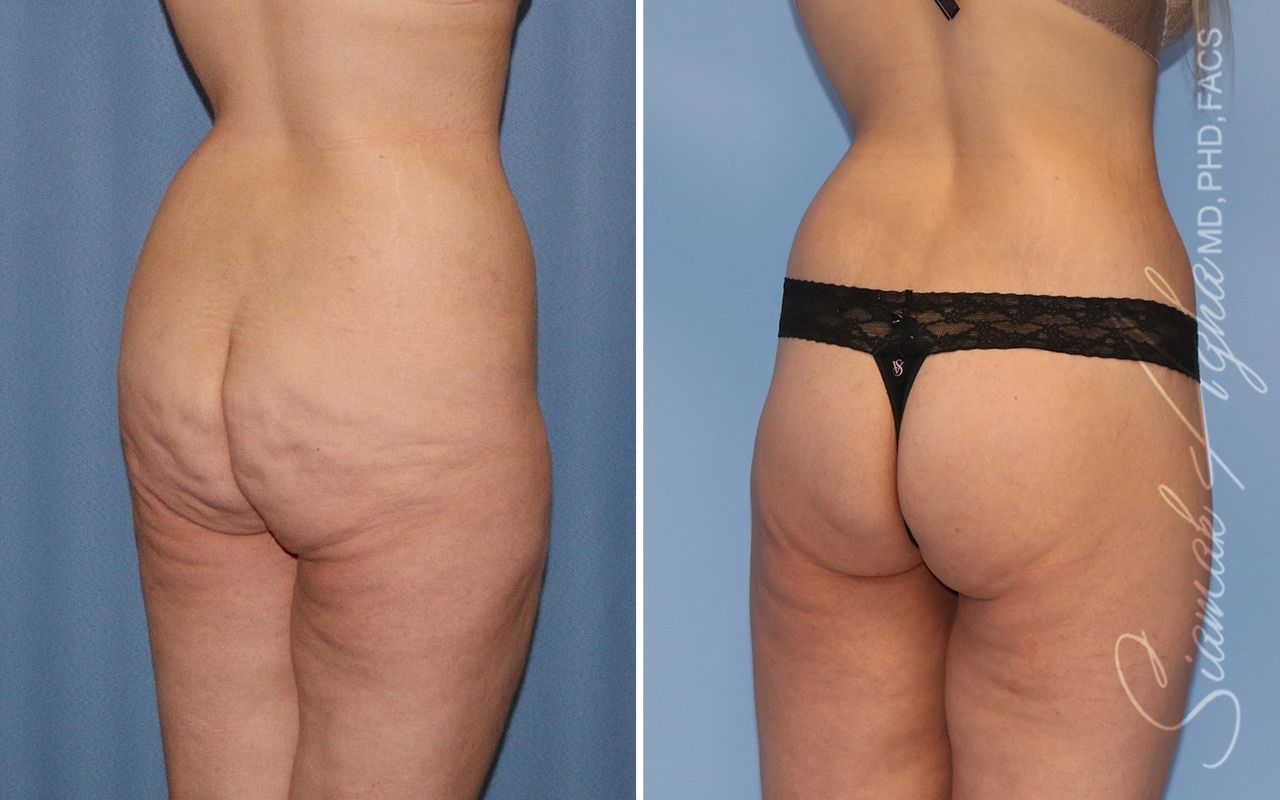 Lower Body Lift Before & After