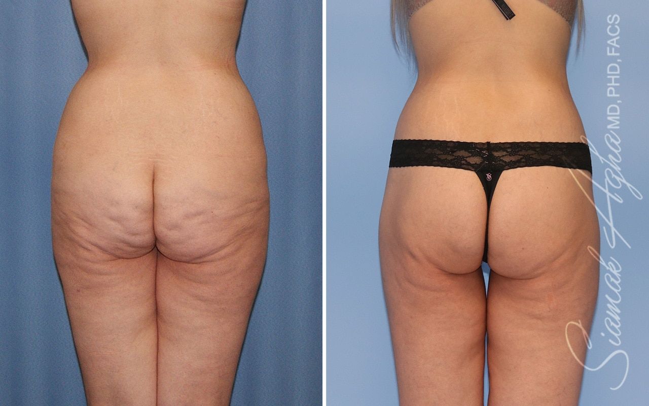 Lower Body Lift Before & After