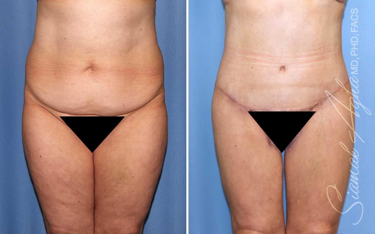Lower Body Lift Before & After