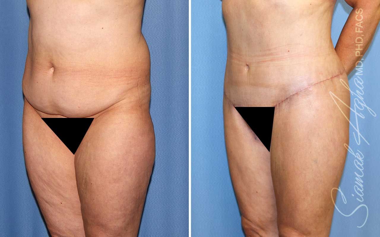 Lower Body Lift Before & After