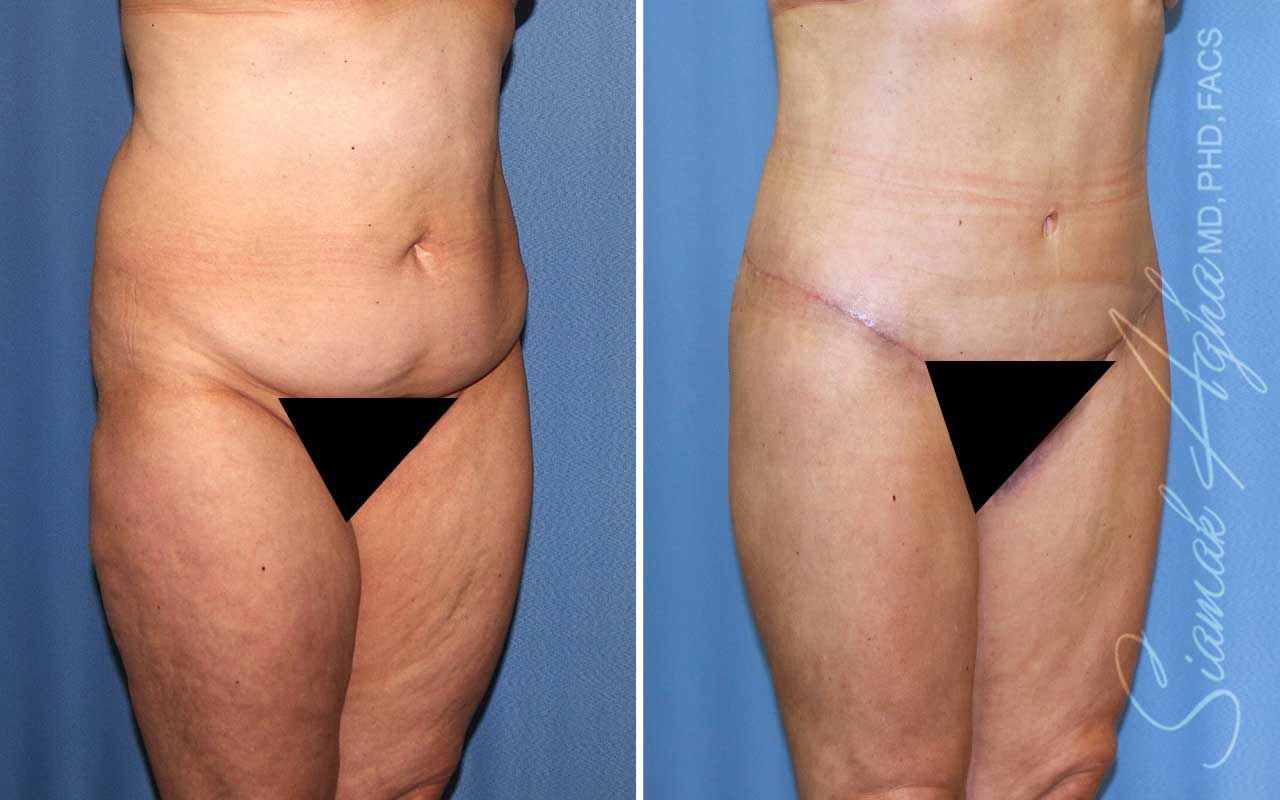 Lower Body Lift Before & After