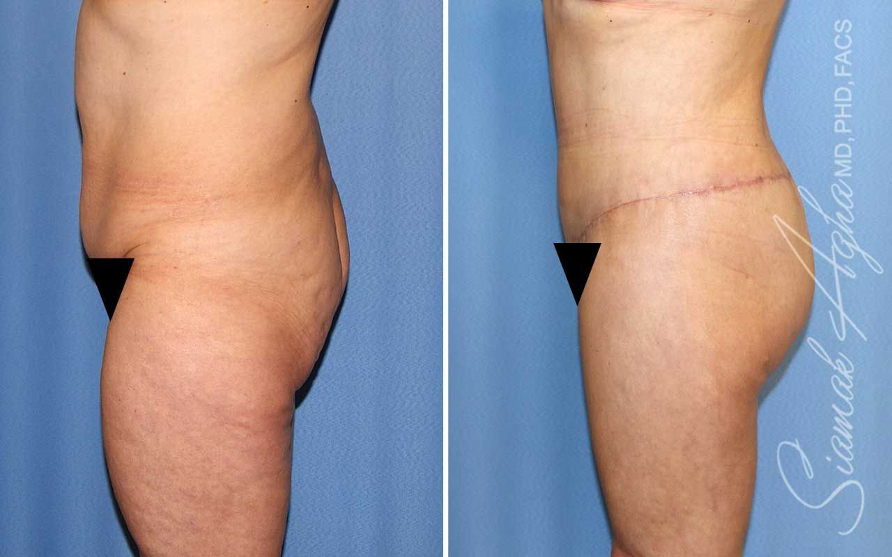 Lower Body Lift Before & After