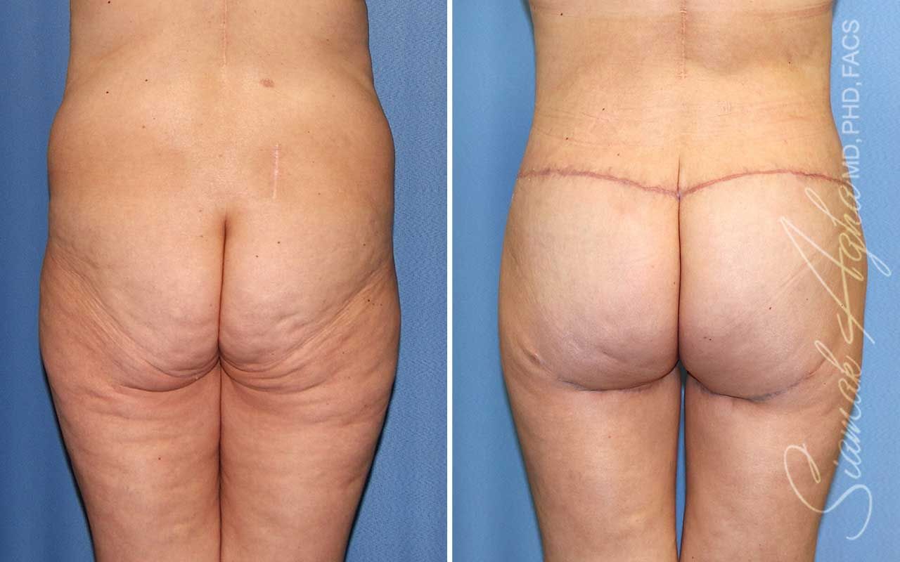 Lower Body Lift Before & After