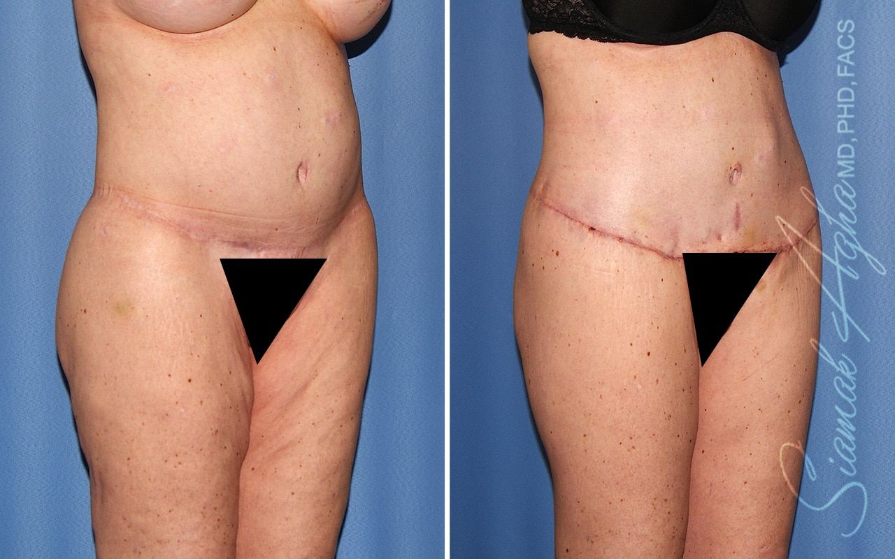 Lower Body Lift Before & After