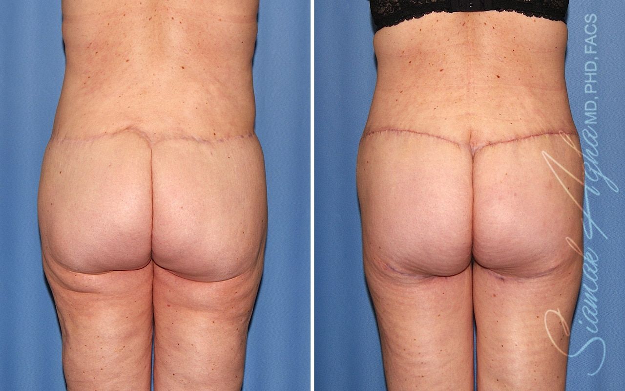 Lower Body Lift Before & After