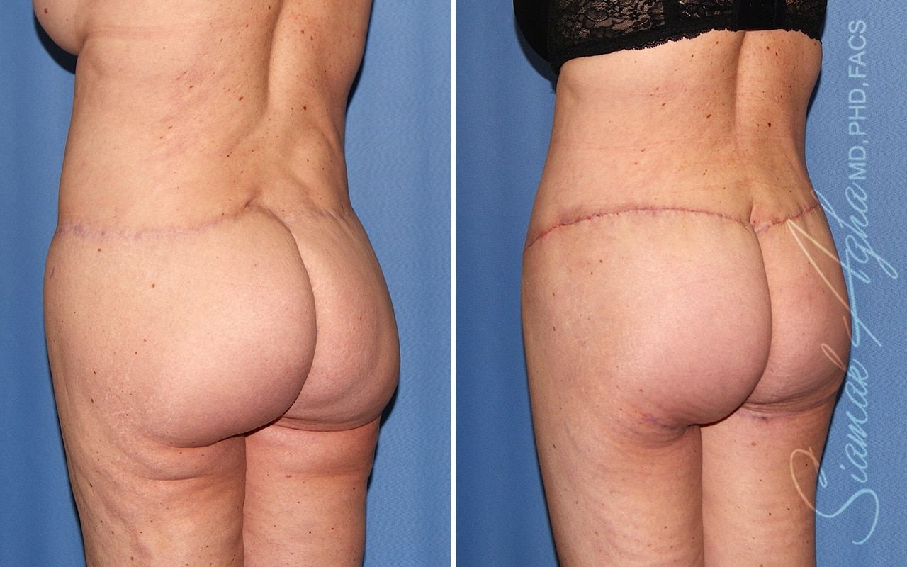 Lower Body Lift Before & After