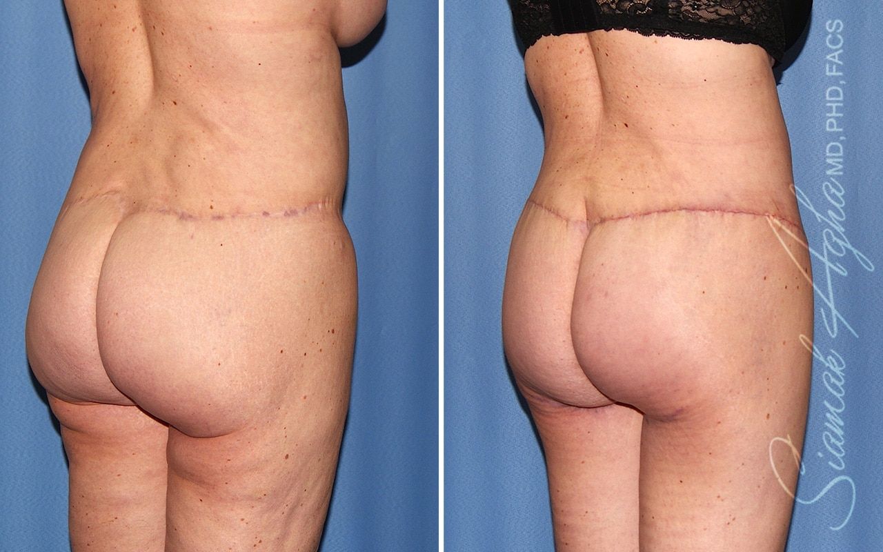 Lower Body Lift Before & After