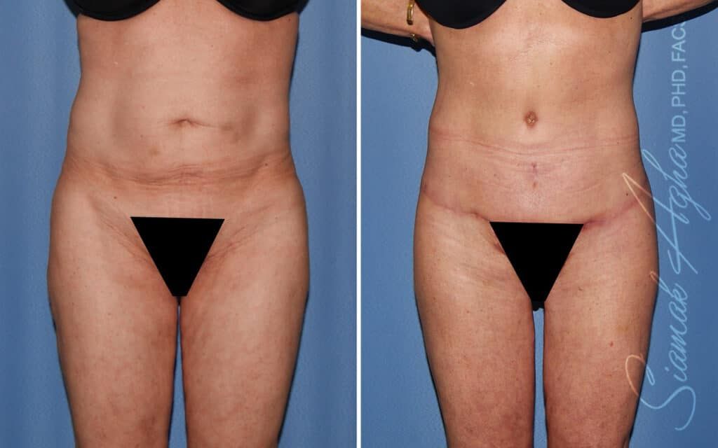 Lower Body Lift Before & After