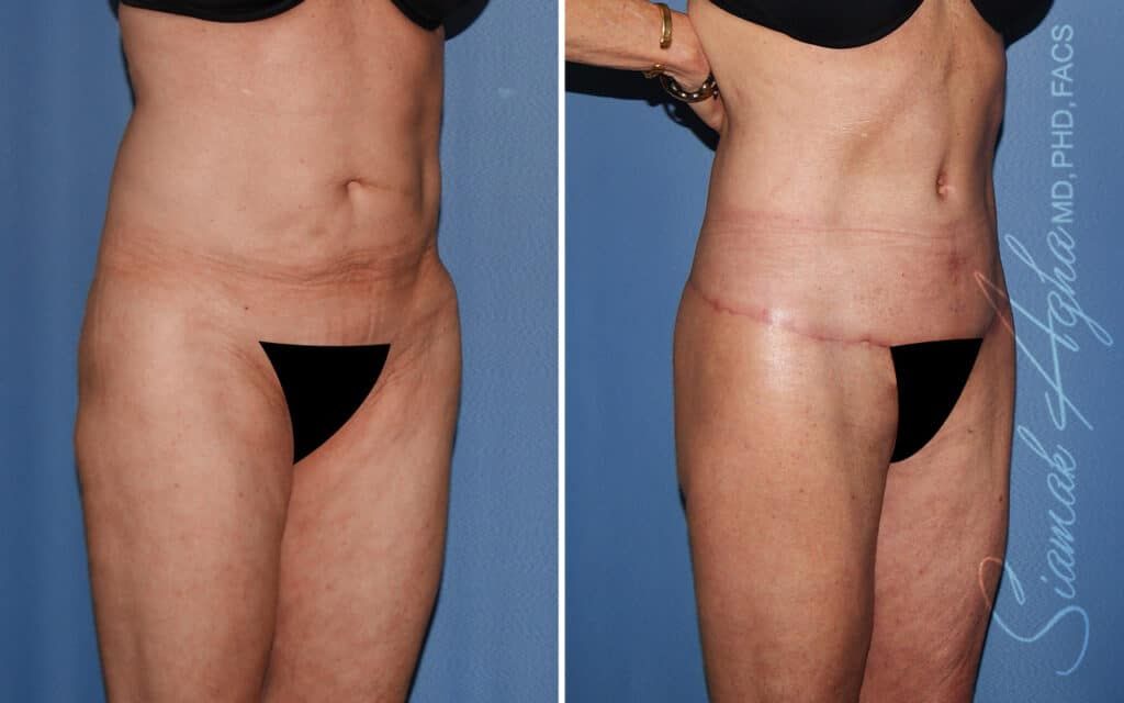Lower Body Lift Before & After