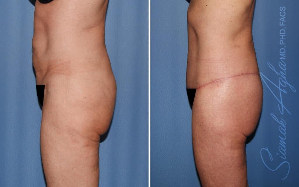 Lower Body Lift Before & After