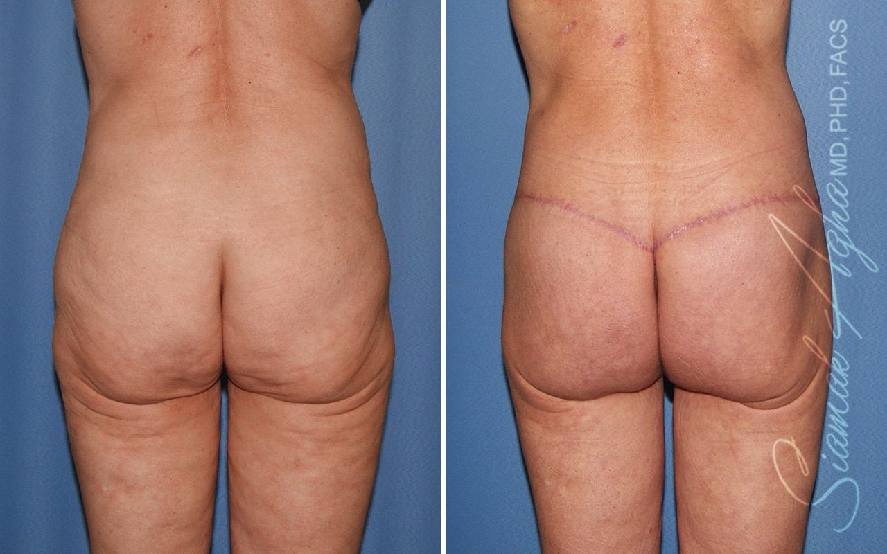 Lower Body Lift Before & After
