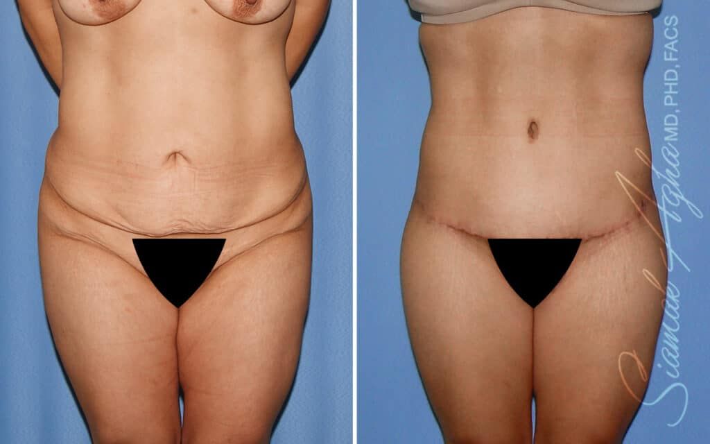 Lower Body Lift Before & After