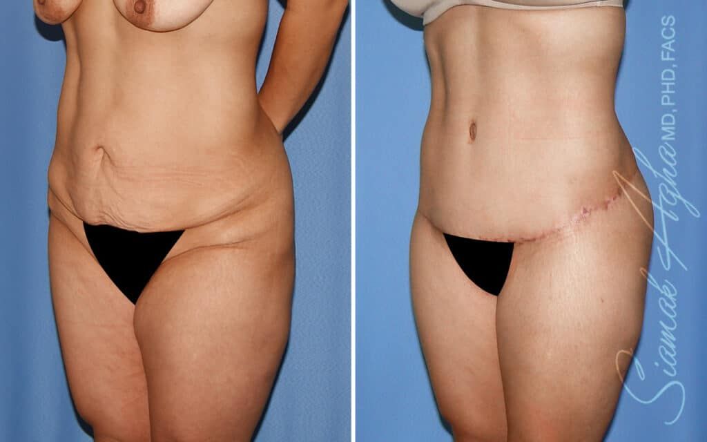 Lower Body Lift Before & After