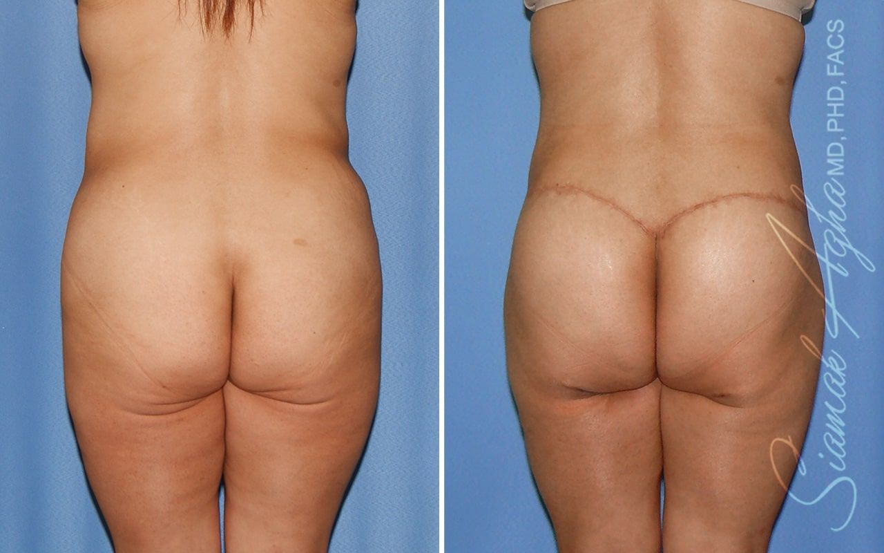 Lower Body Lift Before & After