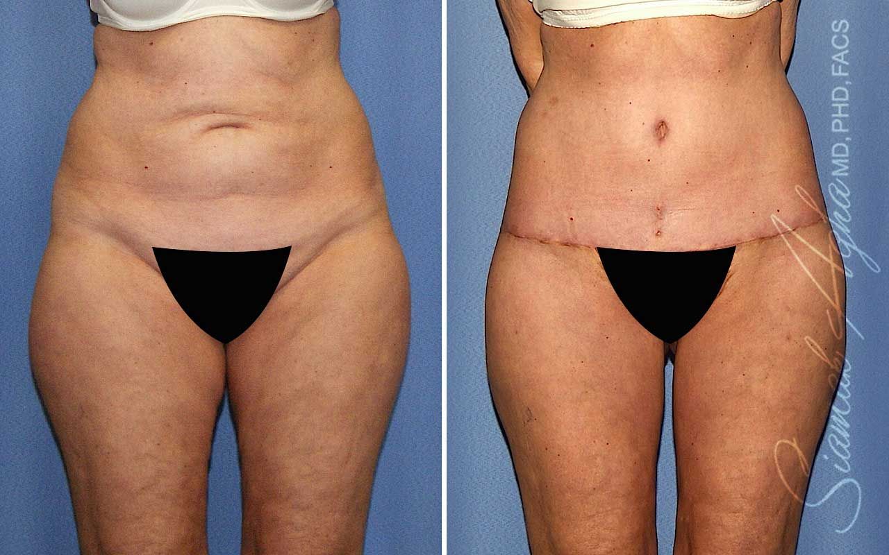 Lower Body Lift Before & After