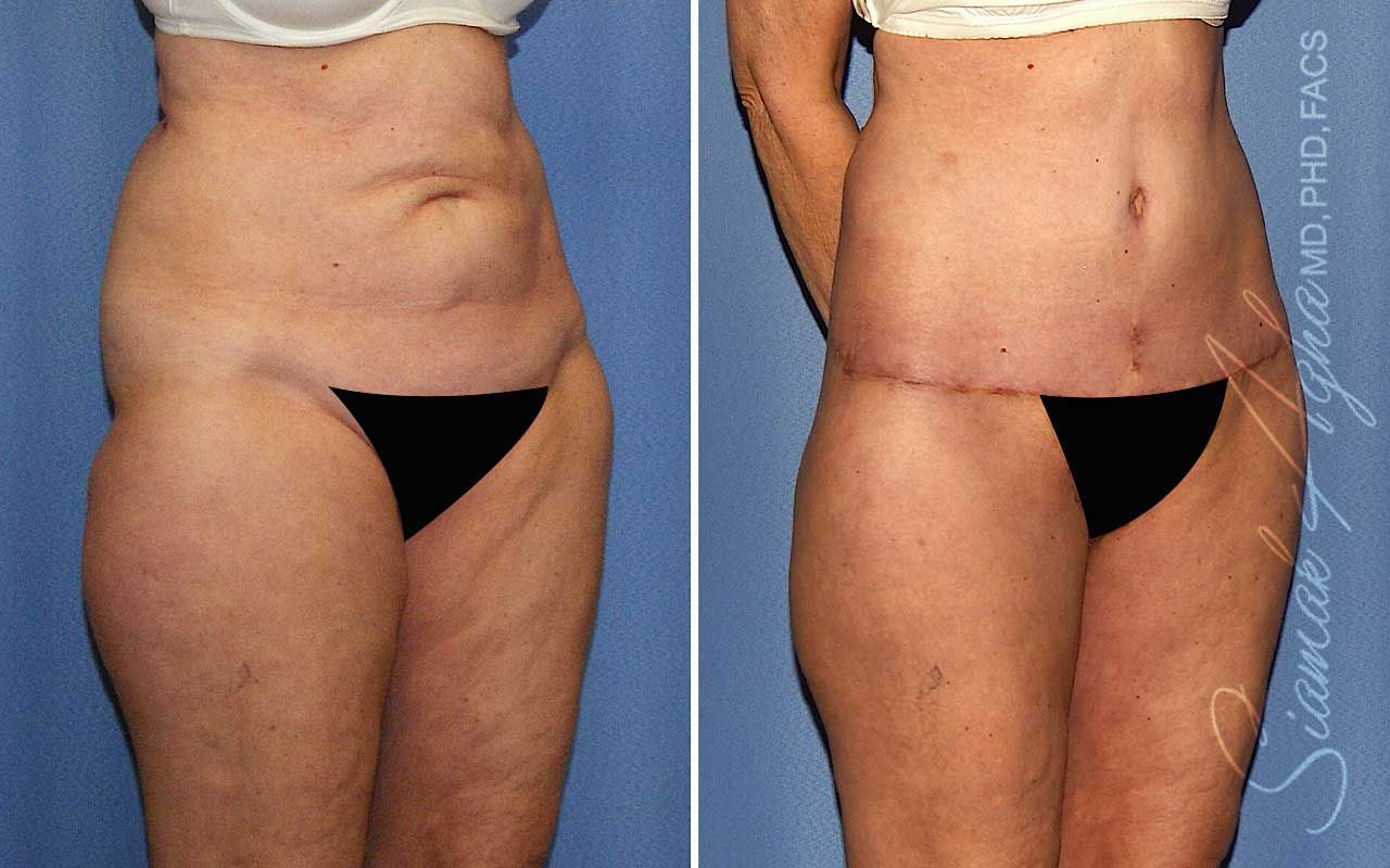 Lower Body Lift Before & After