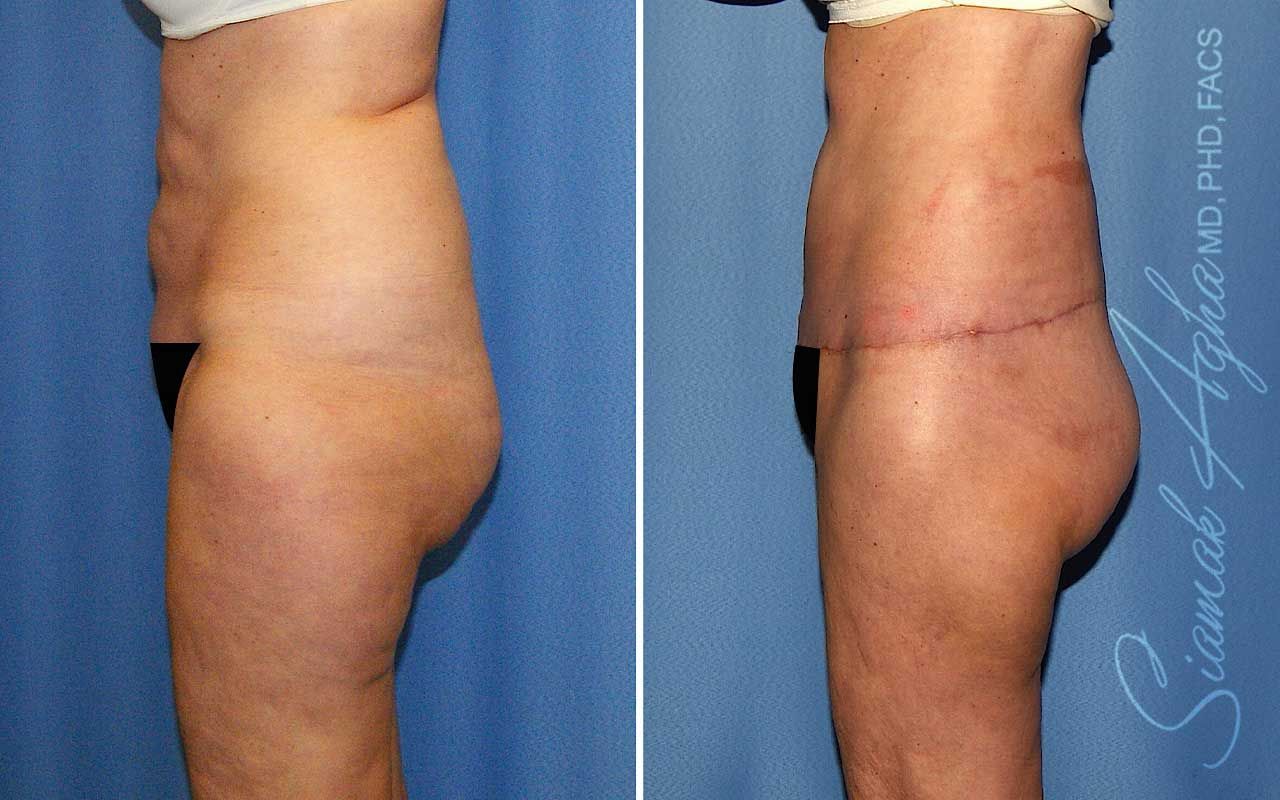 Lower Body Lift Before & After