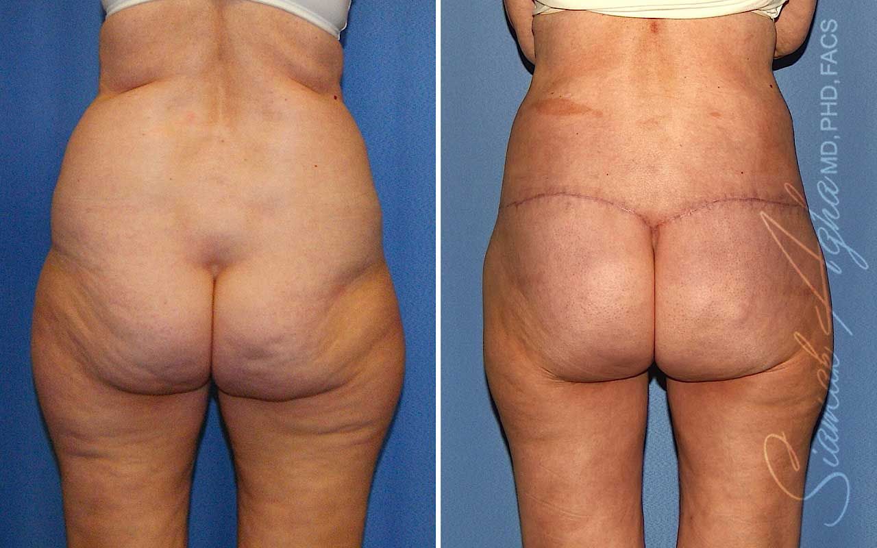 Lower Body Lift Before & After