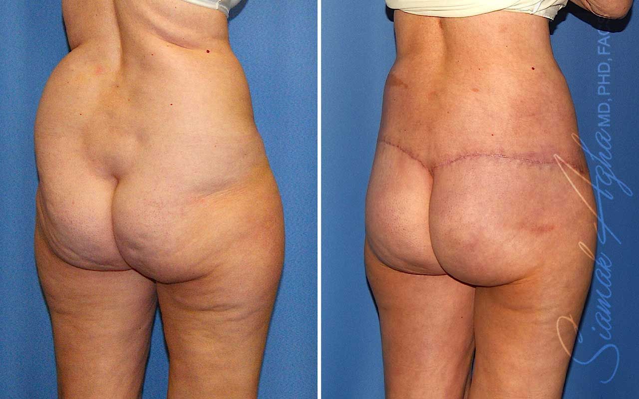 Lower Body Lift Before & After