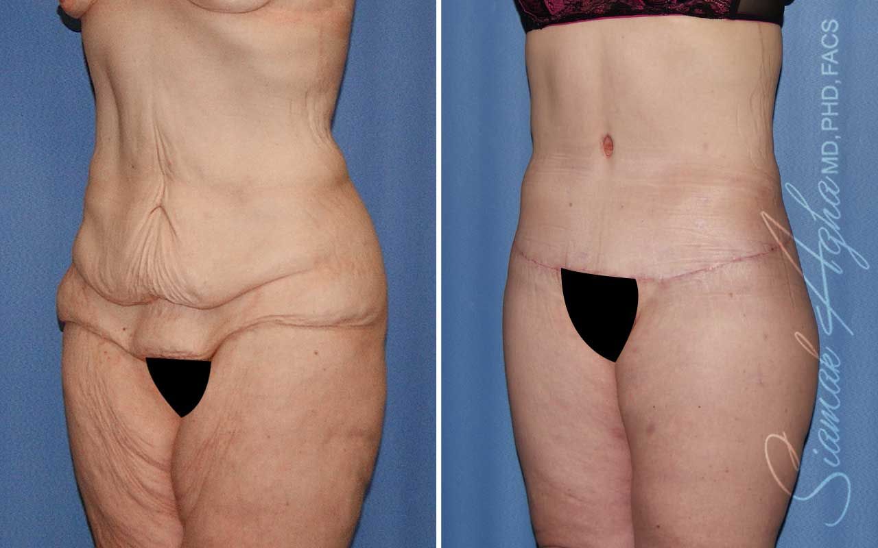 Lower Body Lift Before & After