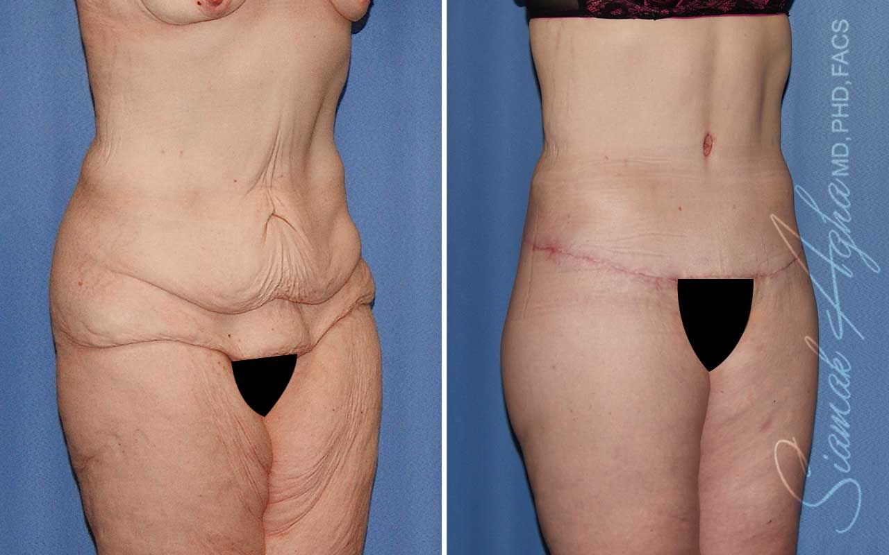 Lower Body Lift Before & After