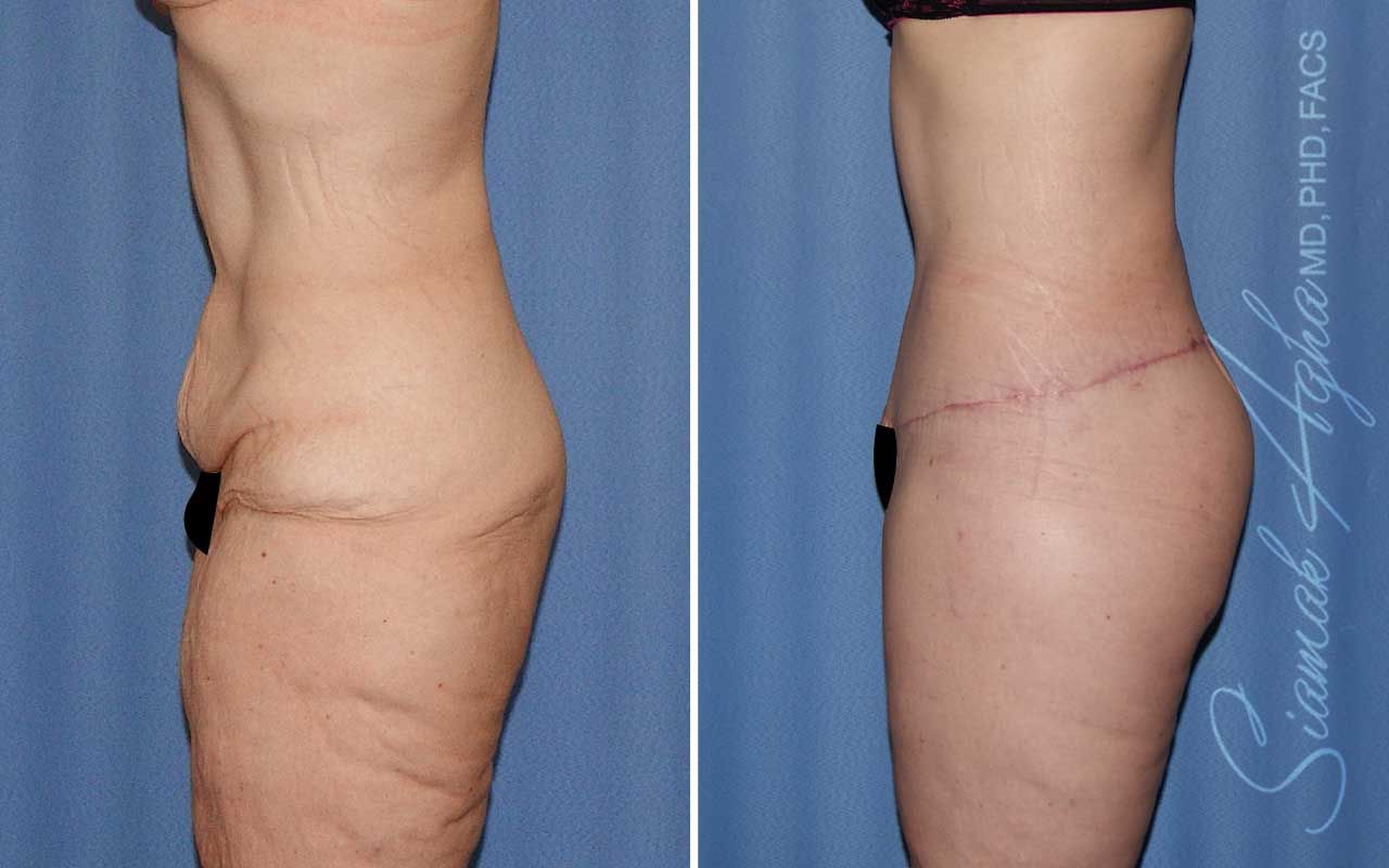 Lower Body Lift Before & After