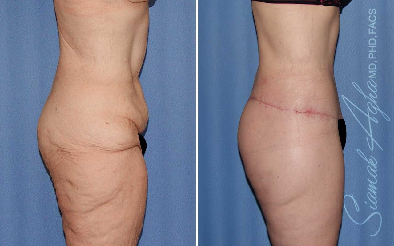 Lower Body Lift Before & After