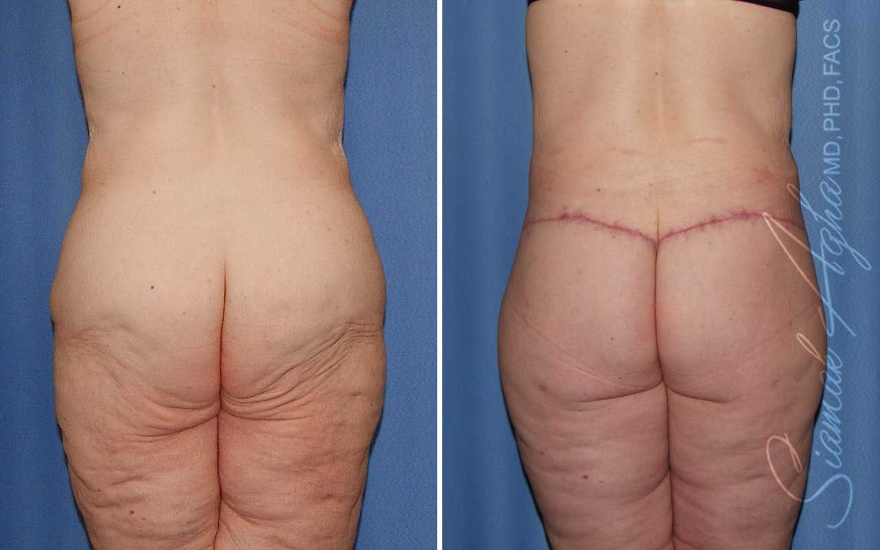 Lower Body Lift Before & After