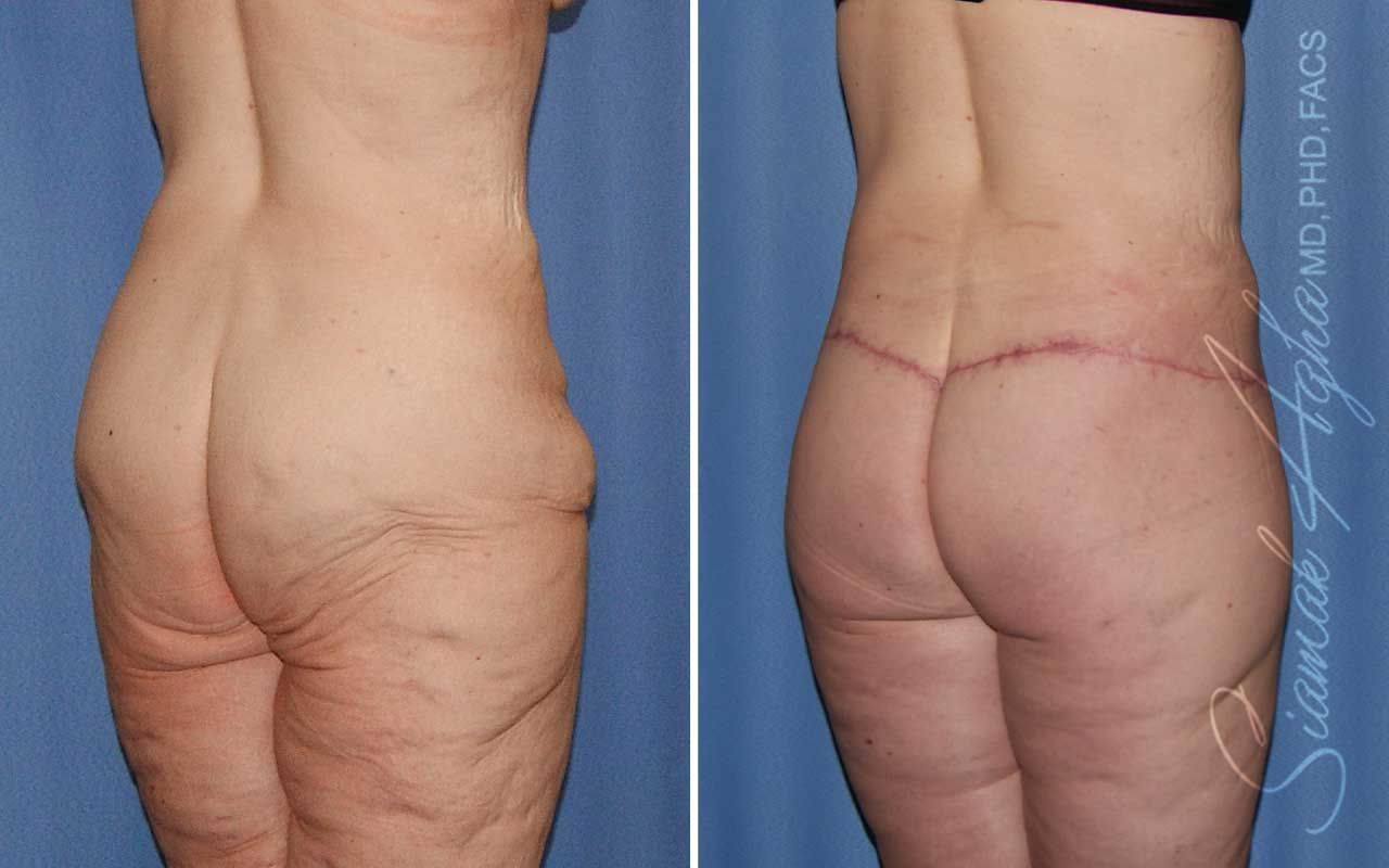 Lower Body Lift Before & After