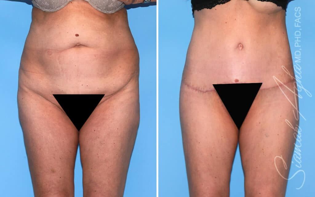 Lower Body Lift Before & After