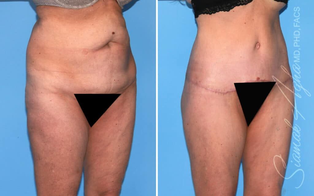 Lower Body Lift Before & After