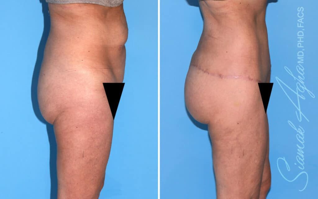 Lower Body Lift Before & After
