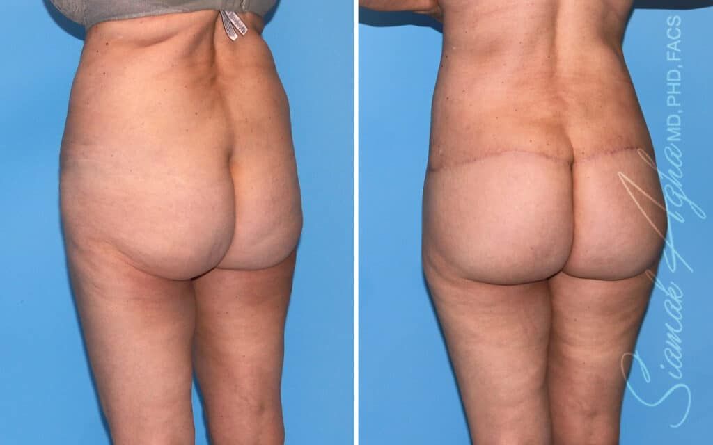 Lower Body Lift Before & After